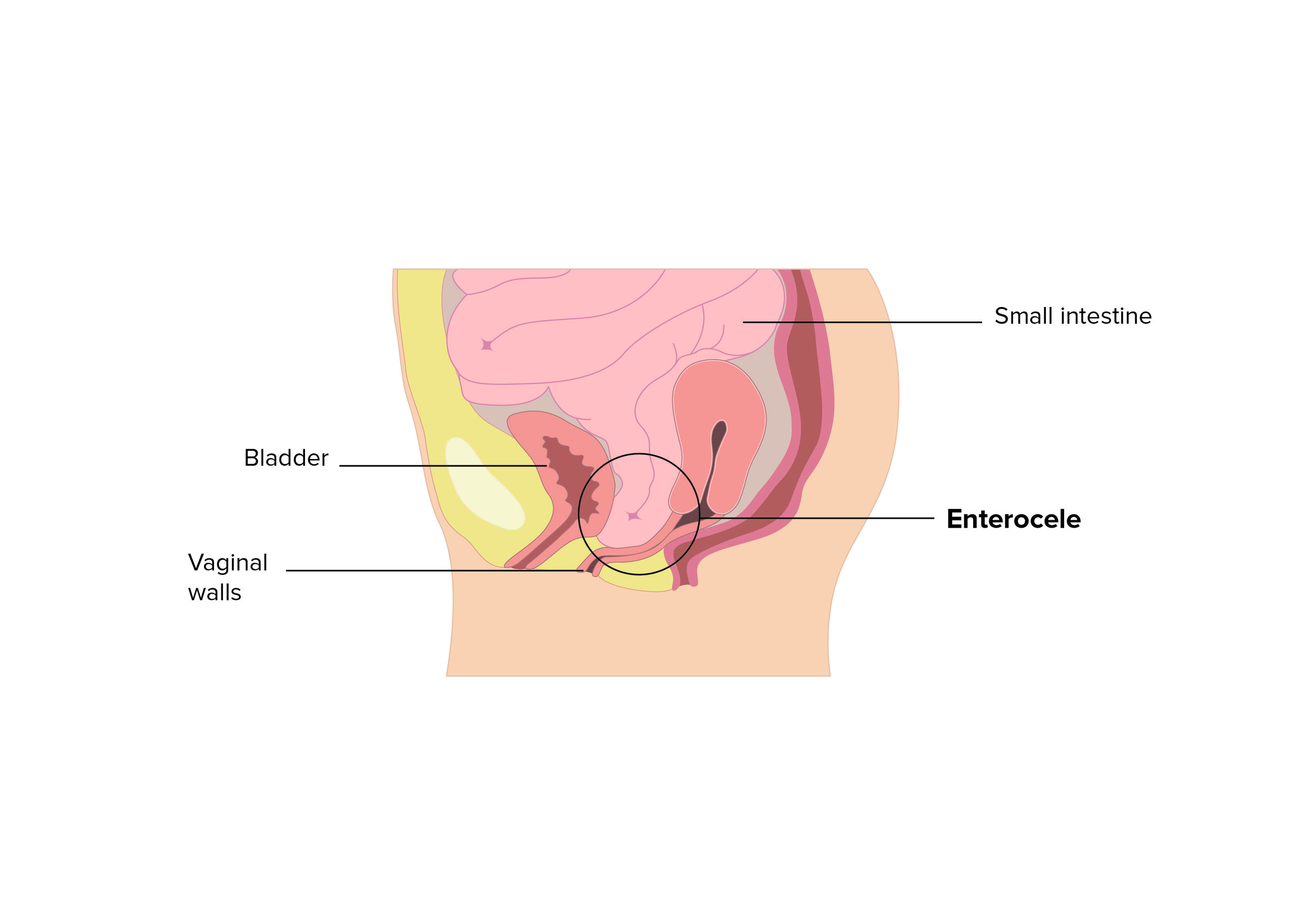 Enterocele front side of vagina.