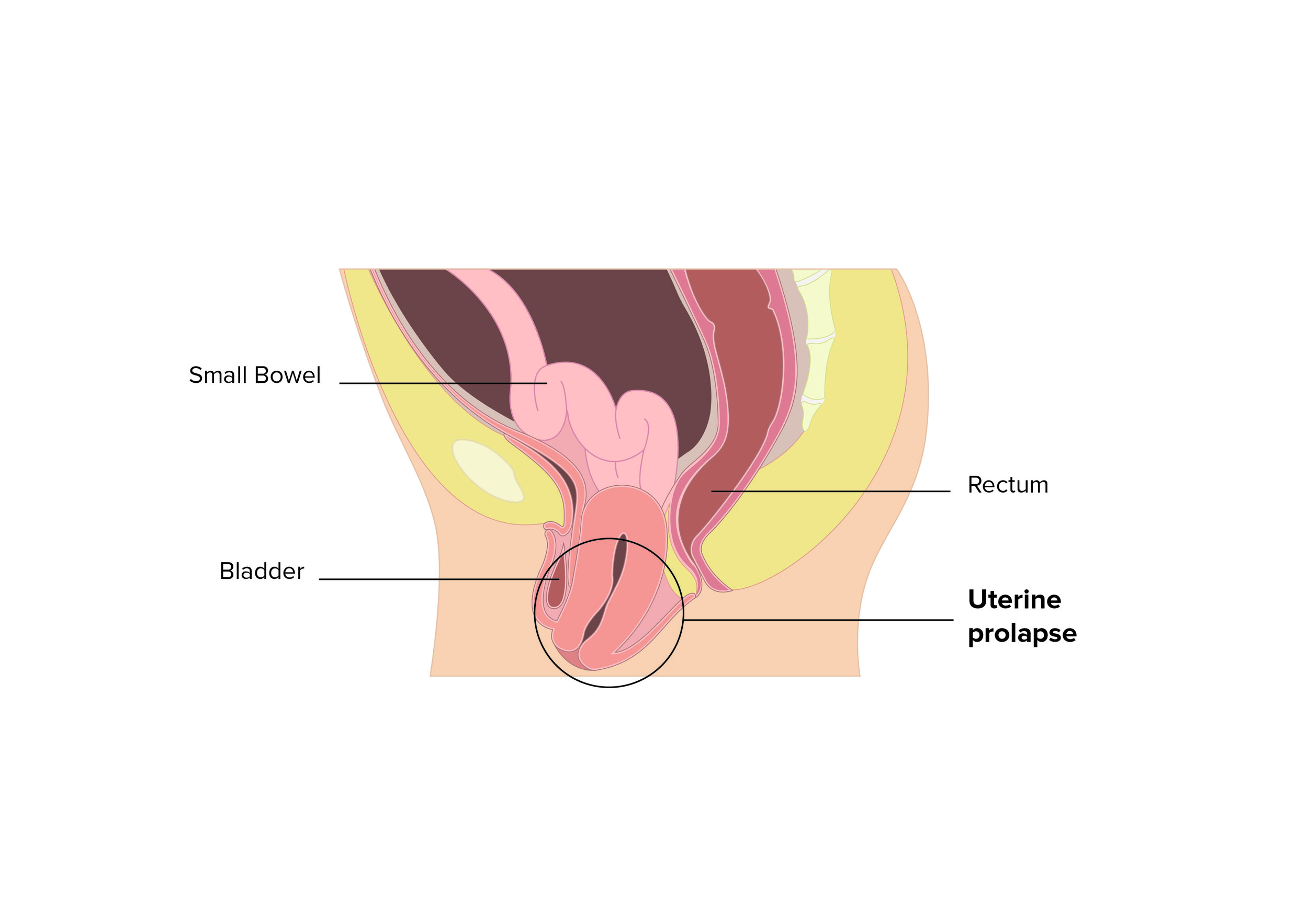 A Woman's Guide to Uterine Prolapse