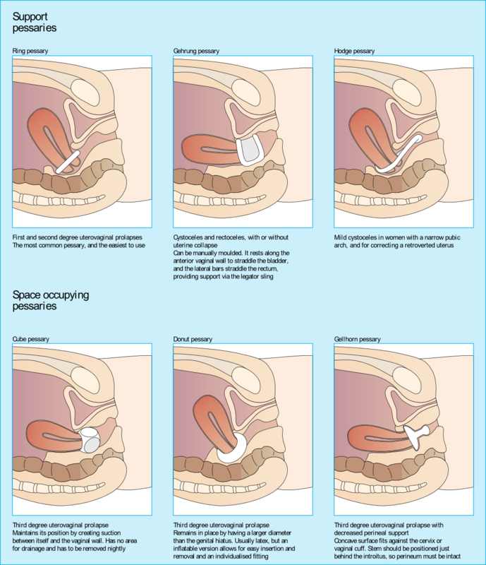 naked hosewives types of vaginal sling