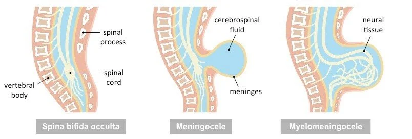 Pelvic Organ Prolapse And Spina Bifida