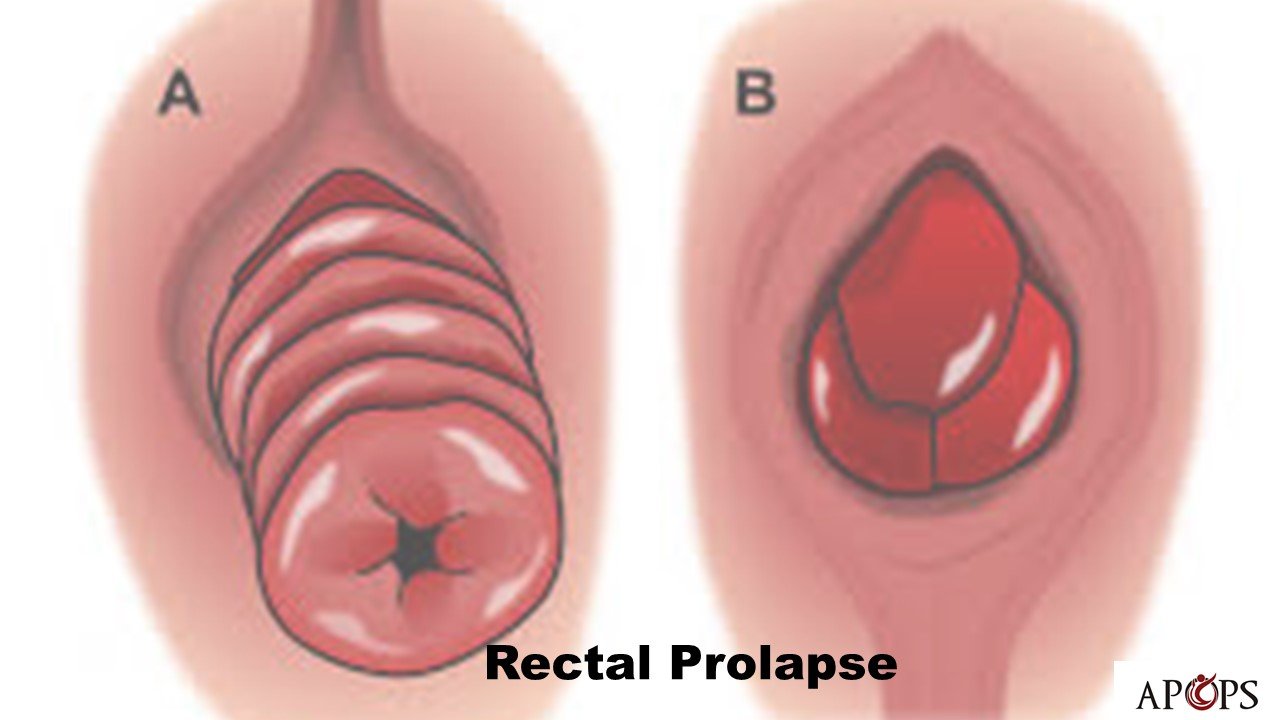 Rectal Prolapse