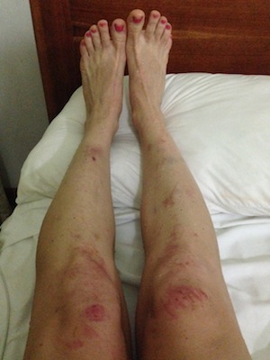 After a hike up Cerro Chato Volcano trail, and mudslide-induced panic attack, my legs were raw, bruised and battered. 