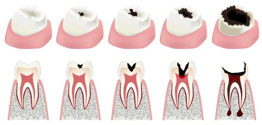 what-causes-cavities-diagram.jpg