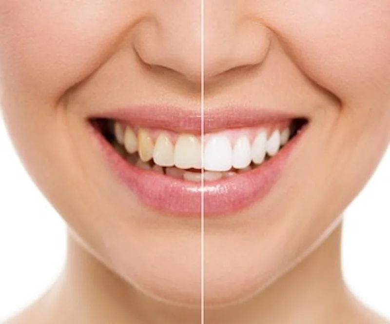 teeth-whitening-before-and-after.jpg