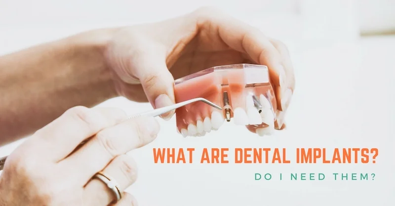 What-Are-Dental-Implants-Do-I-Need-Them.jpg