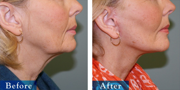 edmonton-cosmetic-surgery-facelift-2.jpg
