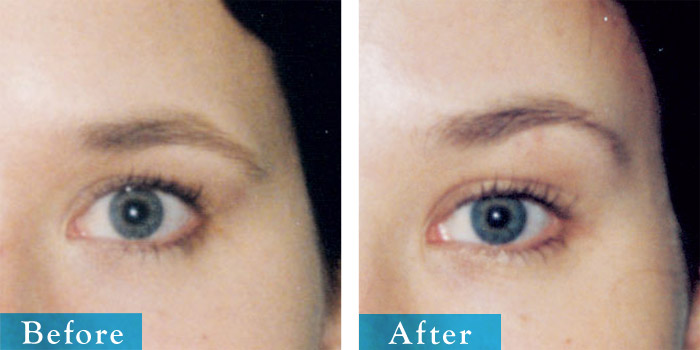  Brow Lift 