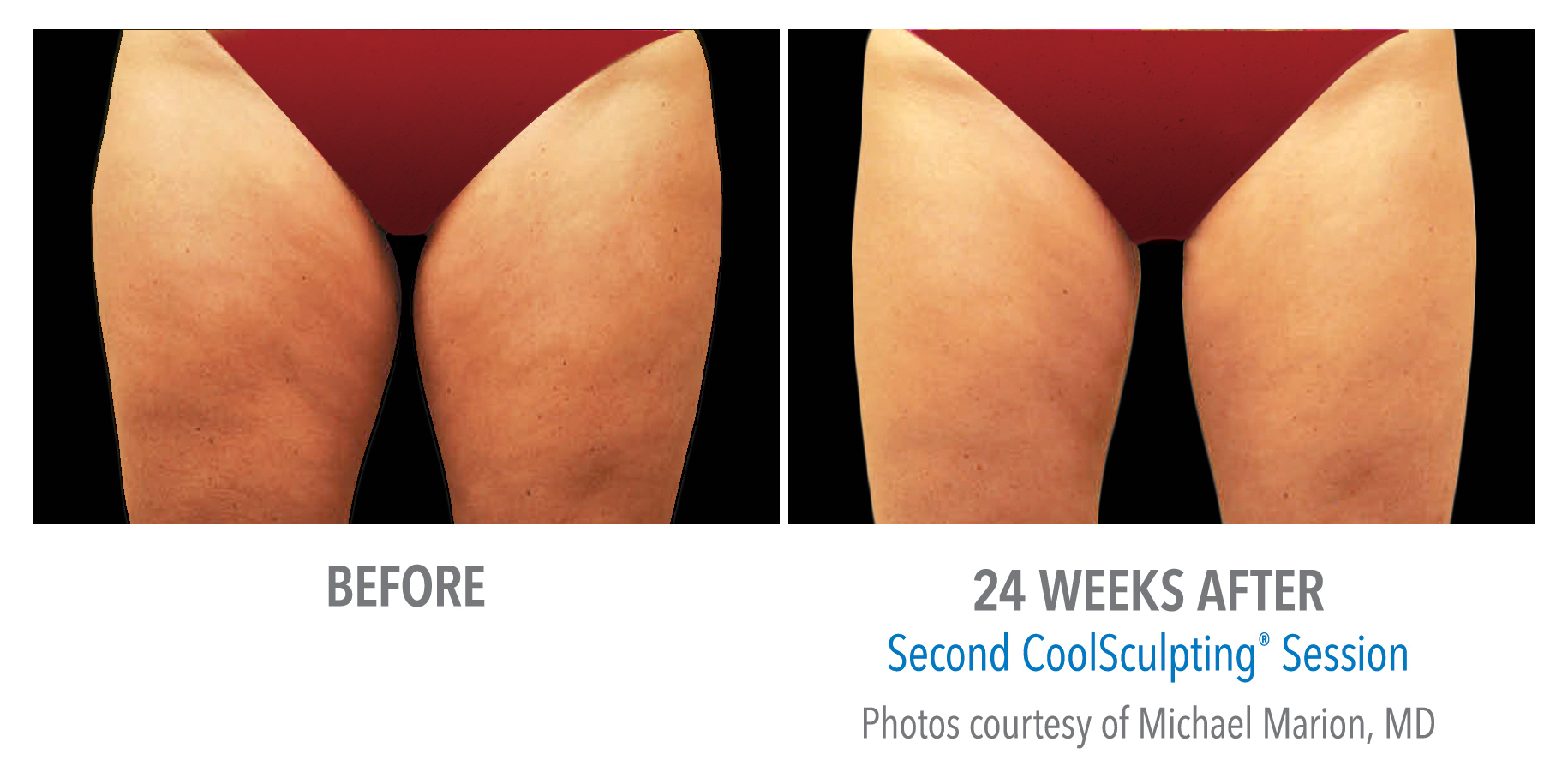 Edmonton CoolSculpting - Reduce Fat Without Surgery — Advanced Facial and  Nasal Surgical Centre