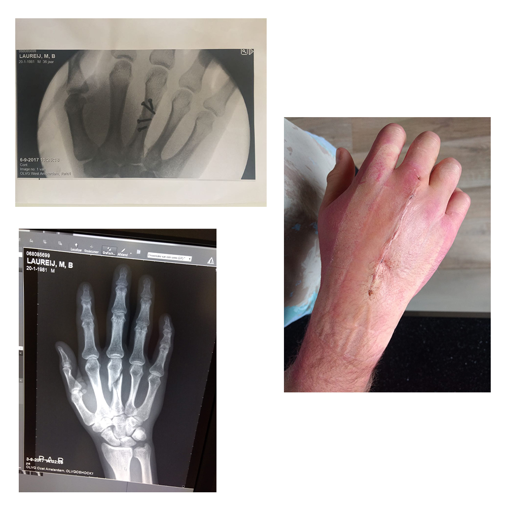 Milo's pop fly injury, August 2017