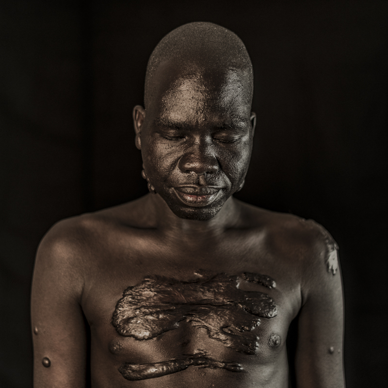 Joseph still bears marks of South Sudan's long and terrible civil war on his body - Photo by Tim Coleman.