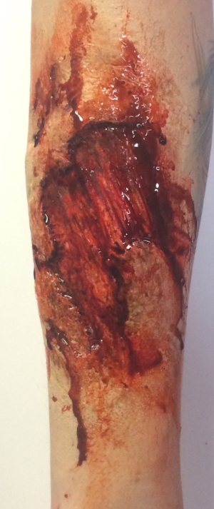 Generic arm wound