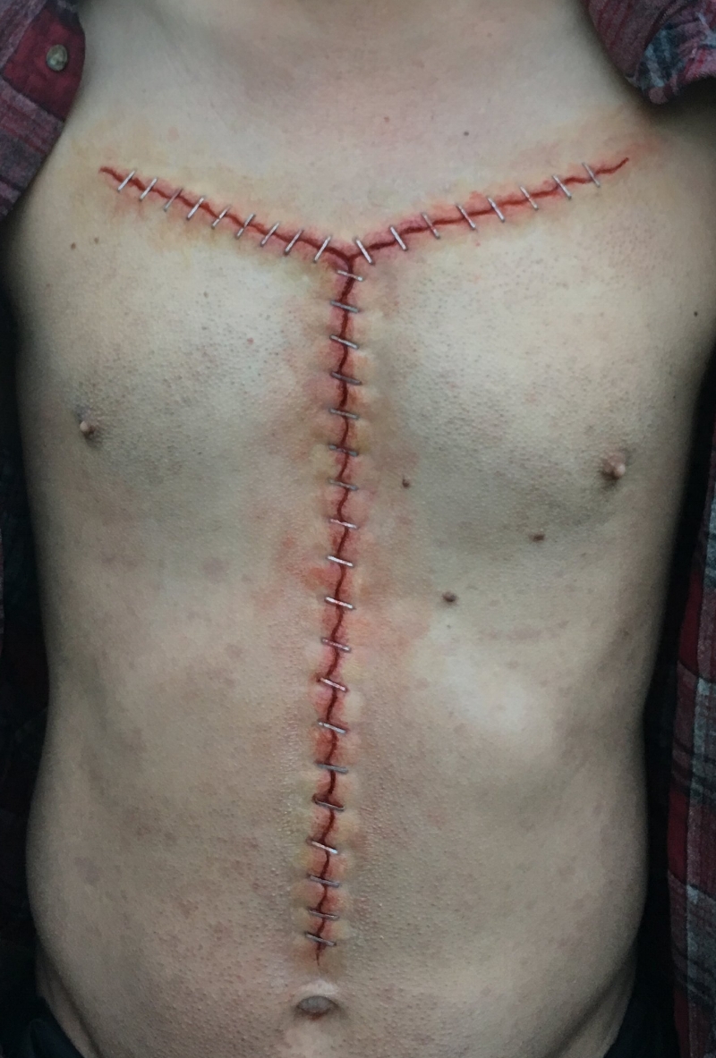 Autopsy