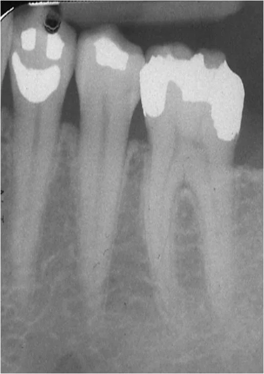 If you have metal fillings in your mouth, you'll want to read this!