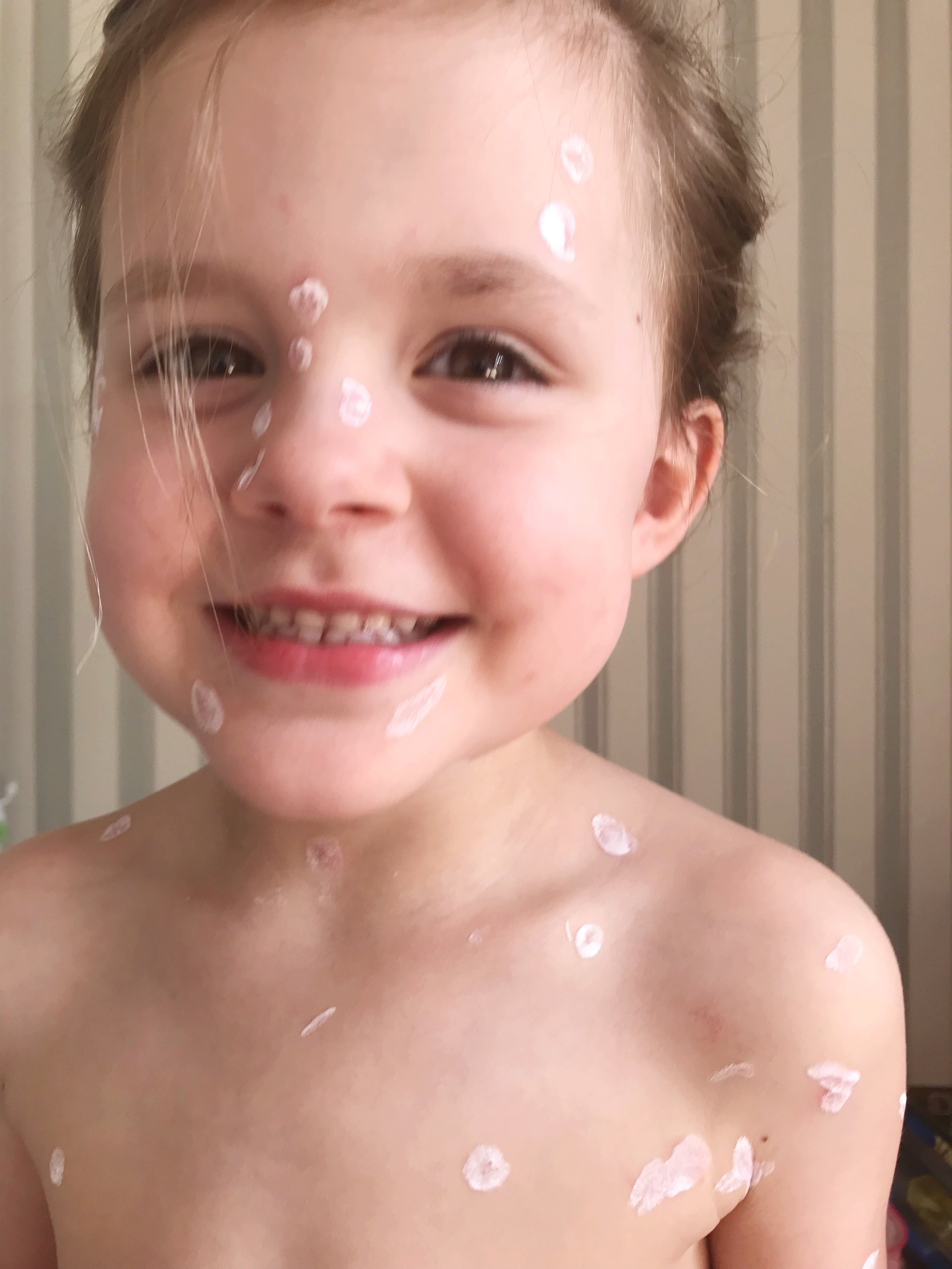 Chicken Pox with Kids | A Memoir