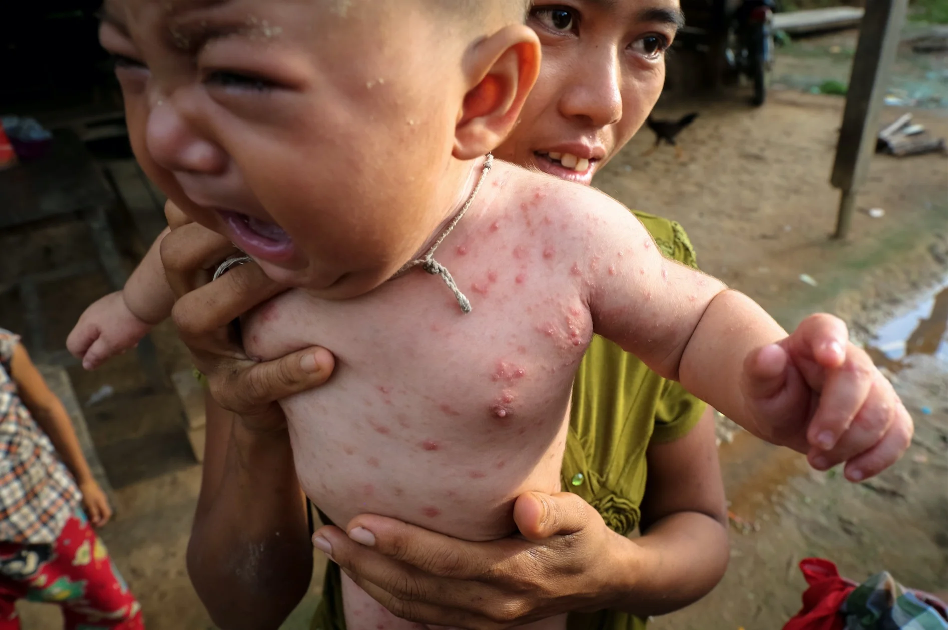 A child covered in a rash. His mother says it comes as a result of contaminated water. Outside Tharzi. July 2017