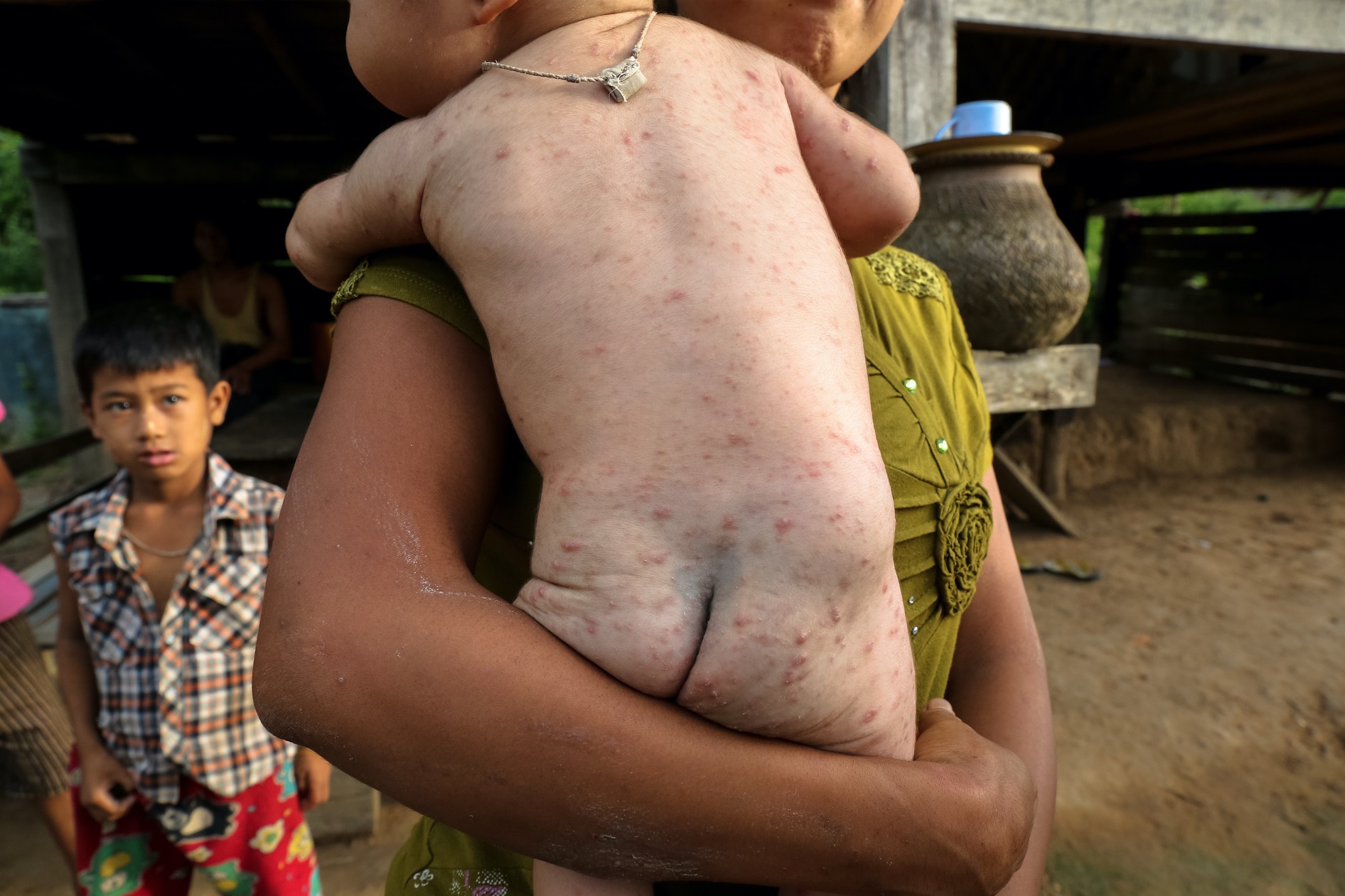 A child covered in a rash. His mother says it comes as a result of contaminated water. Outside Tharzi. July 2017
