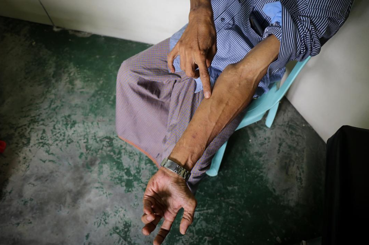 A former intravenous drug user shows scars from his drug-using days. He now have HIV/AIDS and hepatitis C. July, 2018
