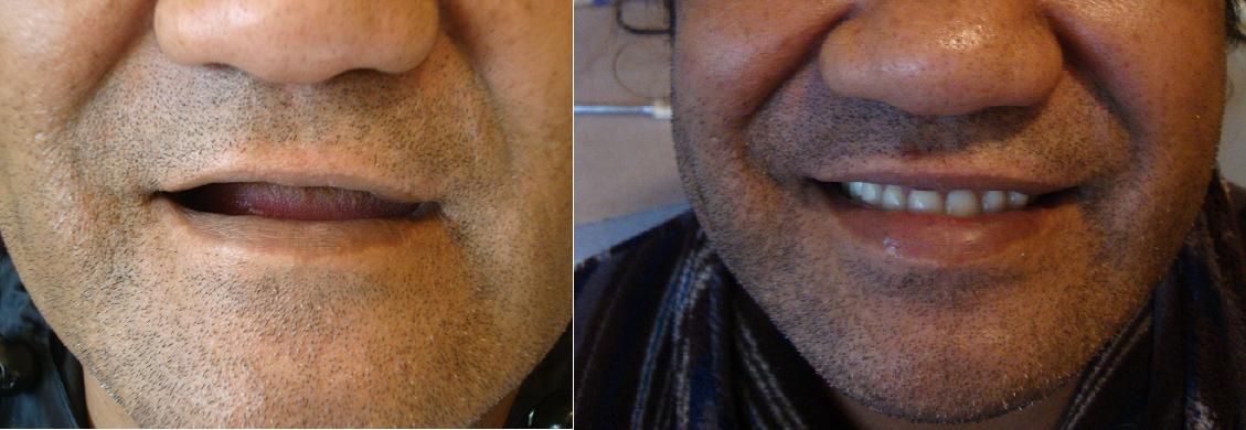 First Full Dentures - top and bottom