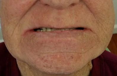 Ultimate face make-over after changing from old worn-out full denture to new Myteeth dentures.