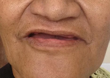 Just got teeth extracted - First time Full Denture