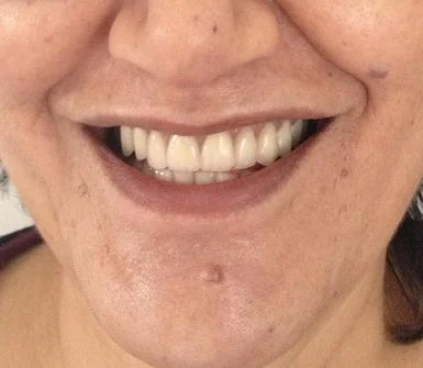 From False-looking denture to Natural-looking denture