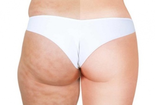 Foto: http://amelioretasante.com/auto-massages-pour-eliminer-la-cellulite/