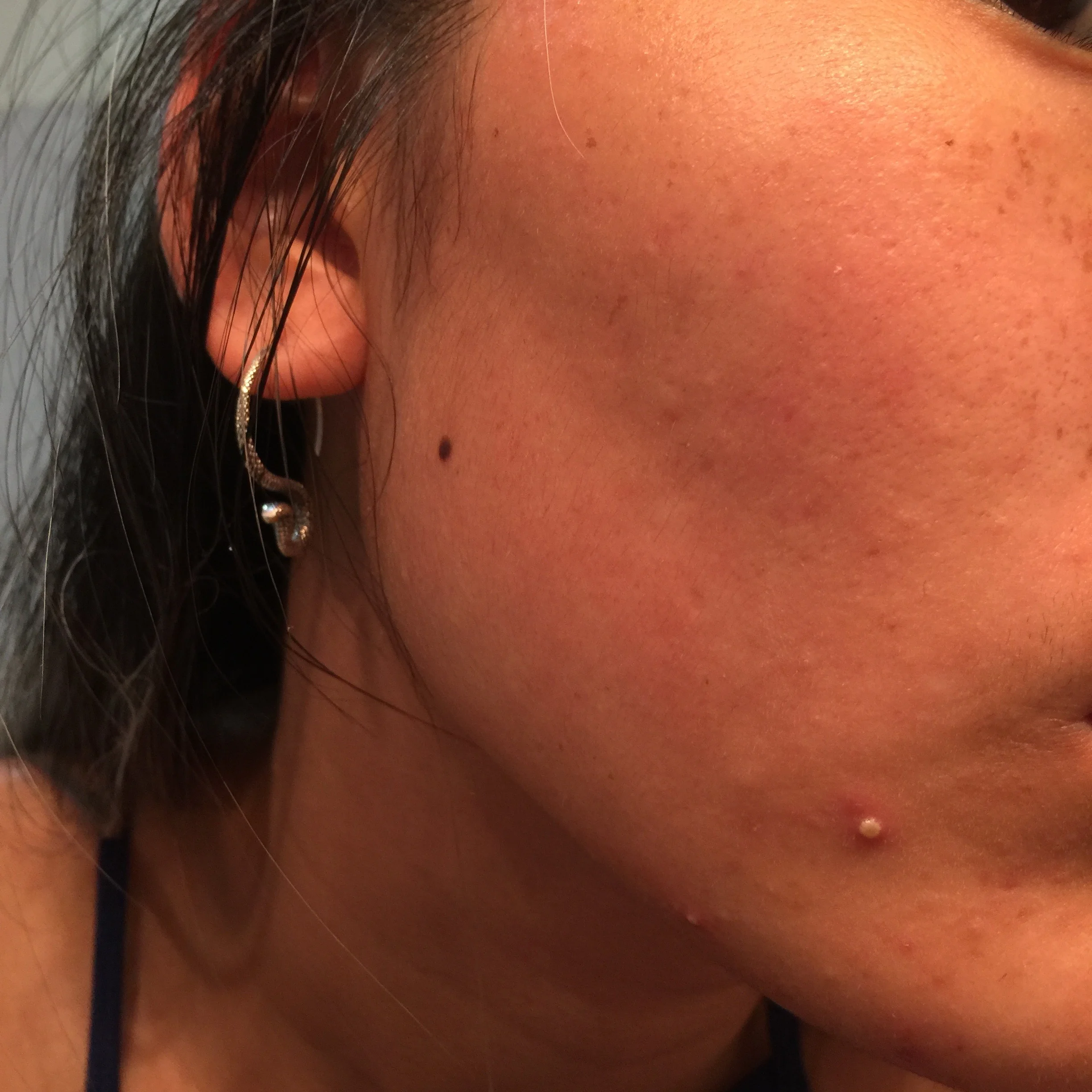 BEFORE: The right side of my face, yes I have a huge ass pimple, I can see that .__.