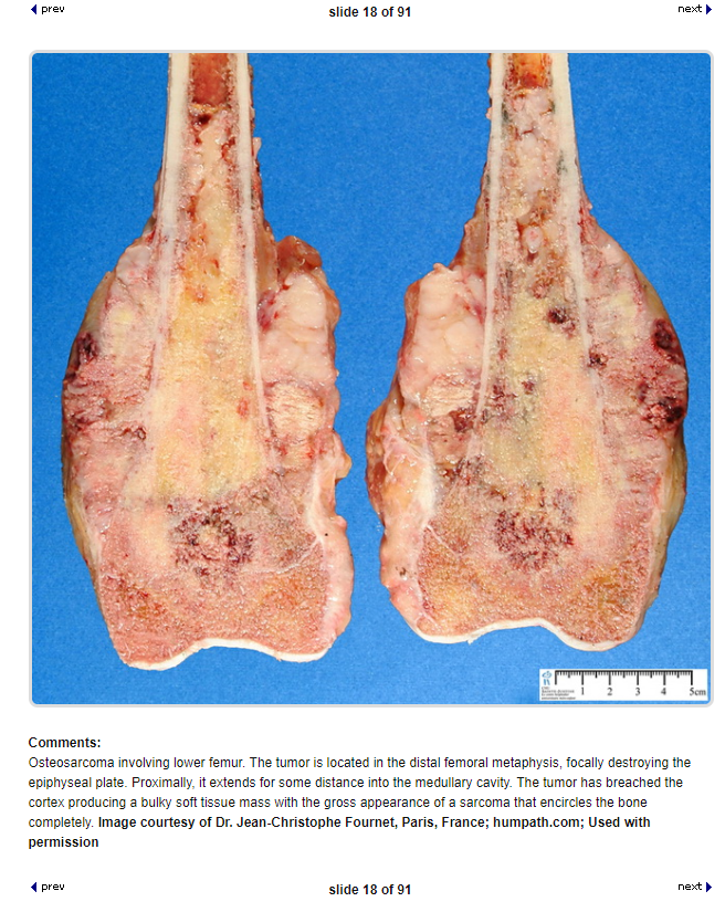 check out more super cool osteosarcoma pics here: https://goo.gl/5Z3Phw