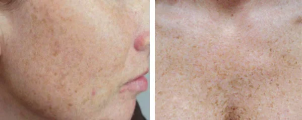 cryopen treatment near me