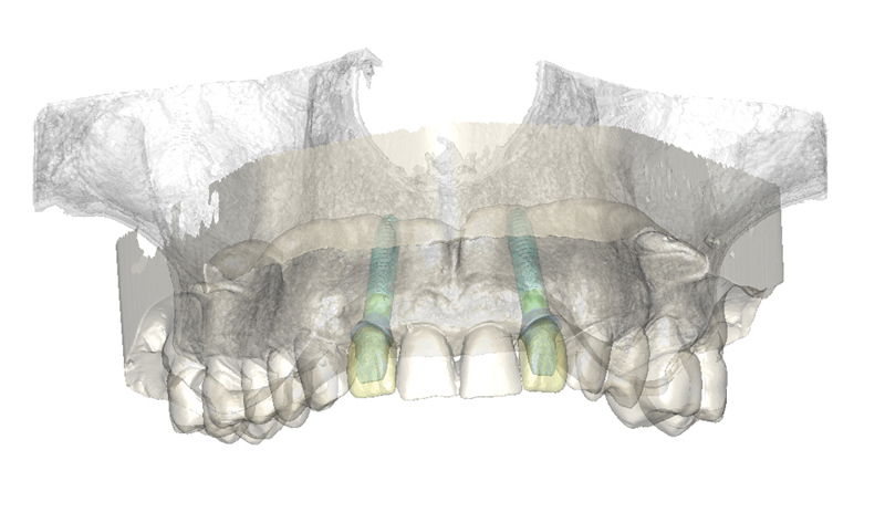 Computer Guided Dental Implant Treatment