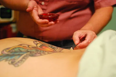 Client receiving Moxibustion warming technique to rebuild energy