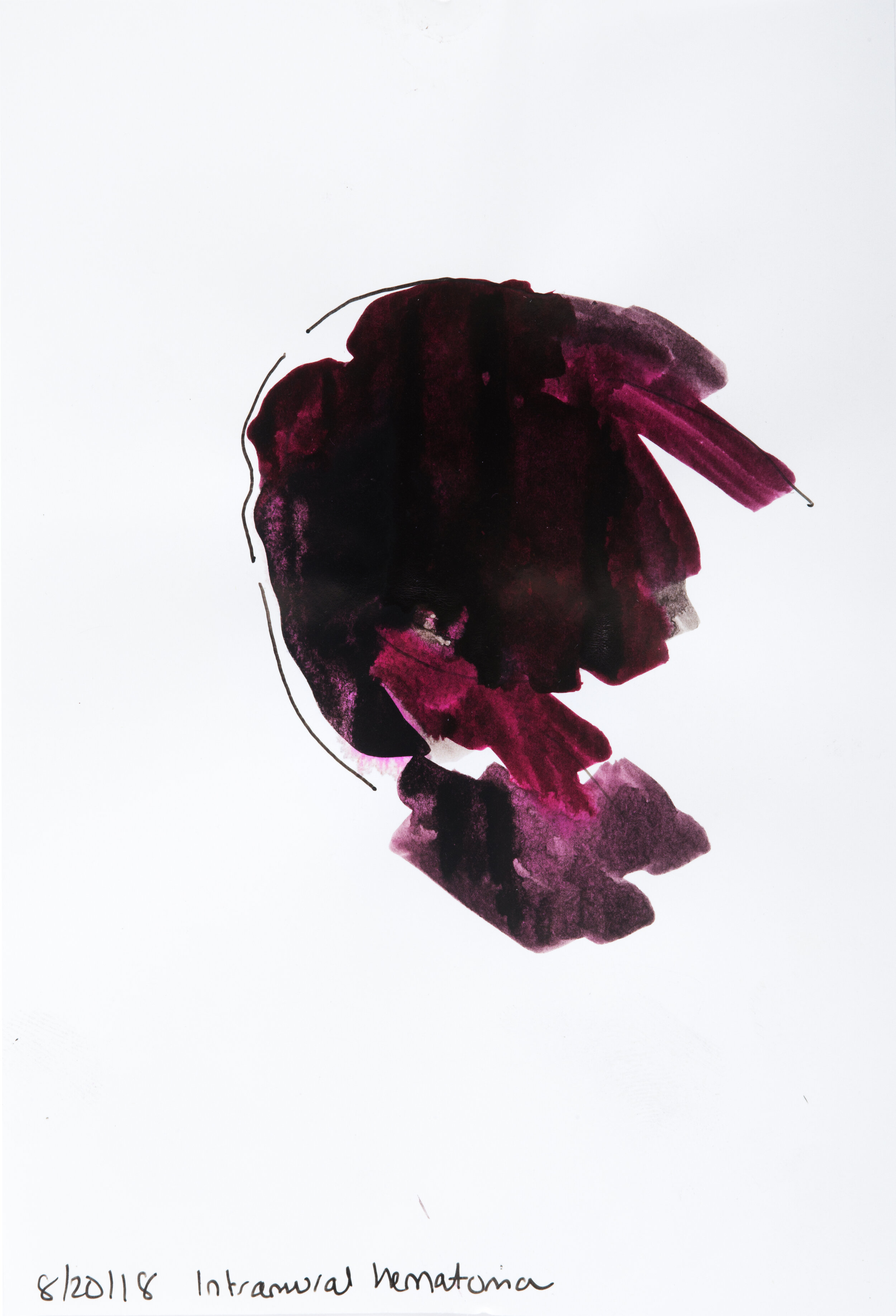 Intramural Hematoma, mixed media