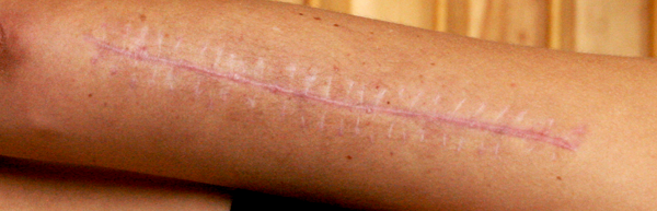 My arm, 5 months after I had surgery to repair my broken humerus in 2007.
