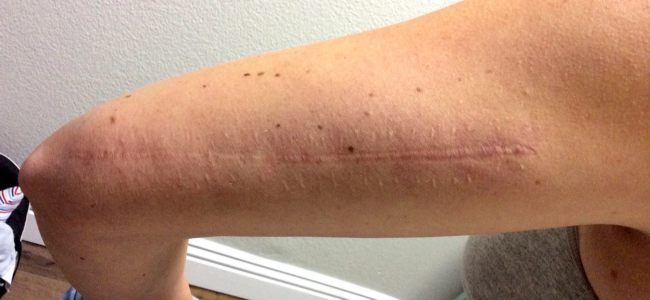 My scar 8 years after surgery but Before we started laser treatment.
