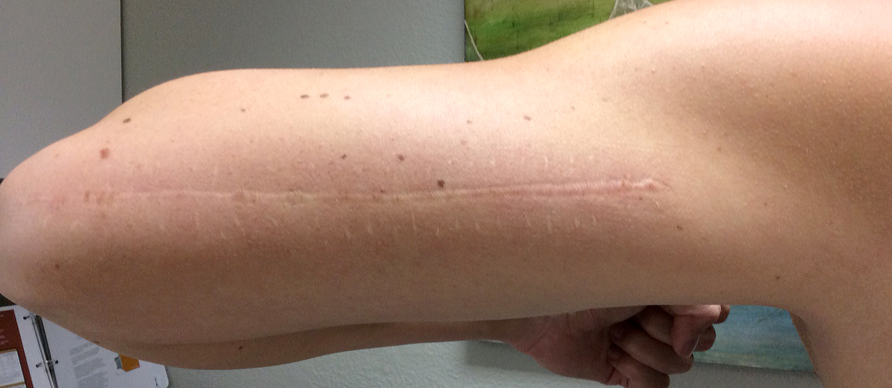 My scar, healed after the first treatment and right before we did the second. Already starting to flatten out!