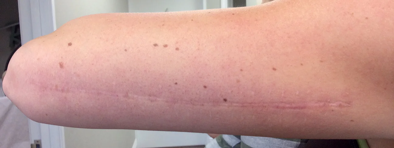 My arm scar healed after the second laser treatment. The skin got a little more red after the second treatment but the scar is shrinking.