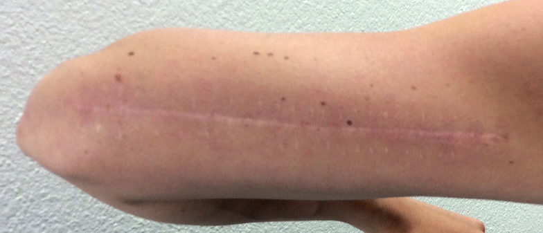 My scar after the final treatment, much more skin toned and a lot flatter.