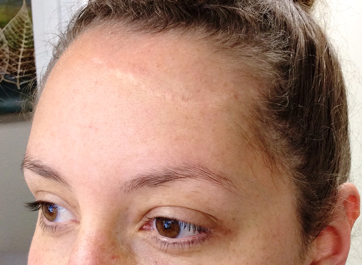 My forehead scar before we started treatment.