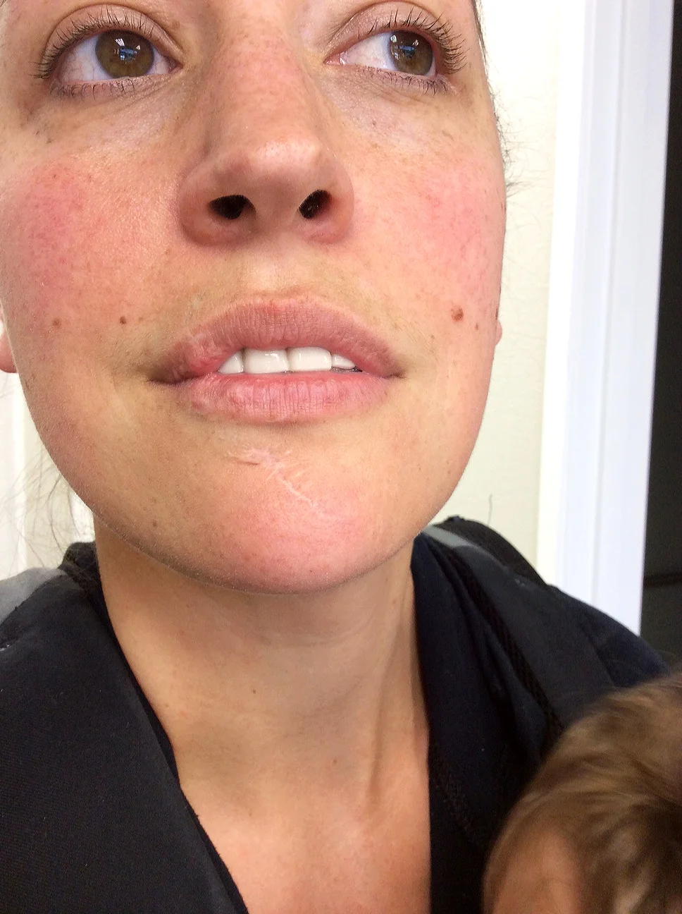 My chin scar, and rosacea before treatment.