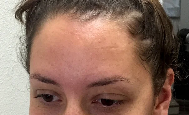 My forehead scar after completing treatment. More filled in and skin toned.