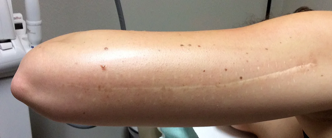 Laser Scar Resurfacing with Cap Aesthetics
