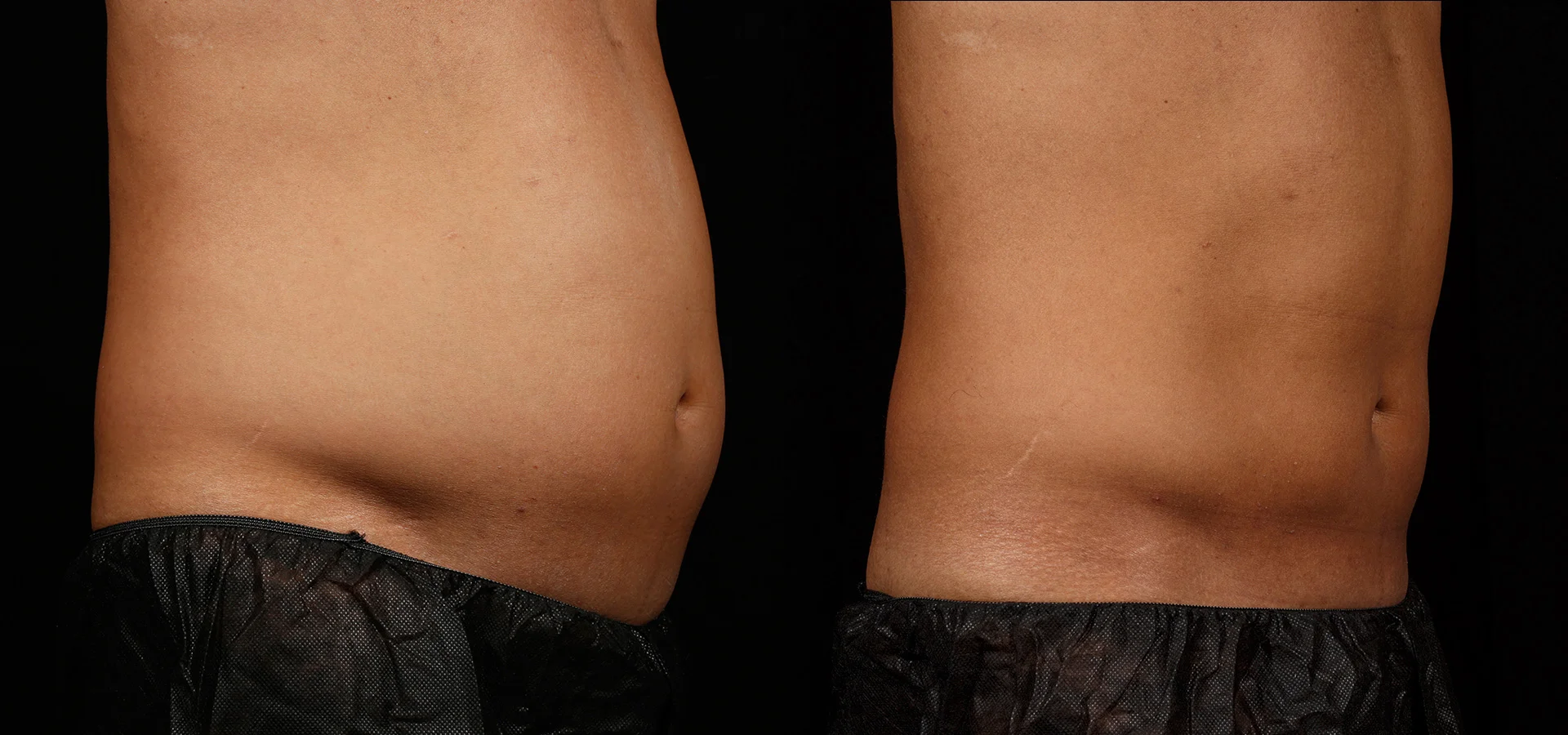 SculpSure Before & After 12 Weeks