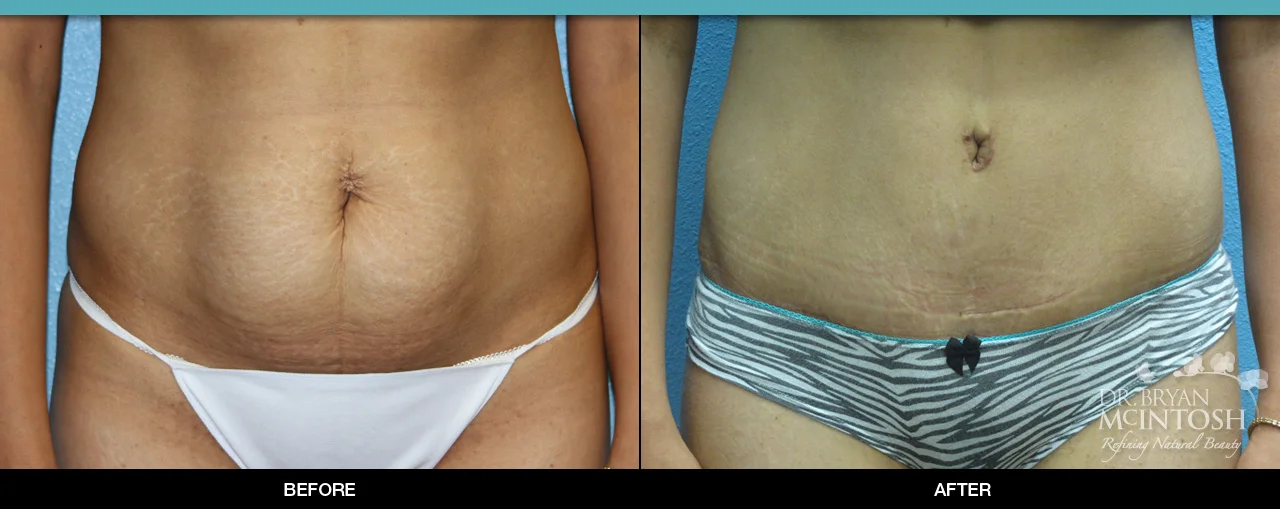 Tummy Tuck Before & After *INDIVIDUAL TREATMENT RESULTS MAY VARY.