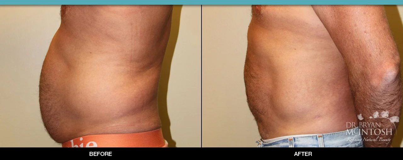 Liposuction Before & After *INDIVIDUAL TREATMENT RESULTS MAY VARY.