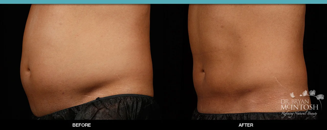 Sculpsure® Before & After 12 Weeks (2 Treatments, Flanks & Abdomen) *Individual Treatment Results May Vary.