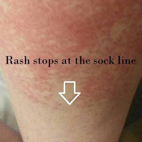 Disney Rash - Exercise-Induced Vasculitis (EIV) often gets misdiagnosed as an allergic reaction because it often stops at the sock line.