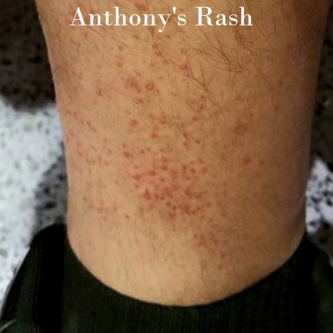 Skin Allergy Diseases Problem, Poison Tree Contact Dermatitis Rash By Pant,  Female Dermatology Patient With Allergic Eczema On Arm. Stock Photo,  Picture And Royalty Free Image. Image 147944984.