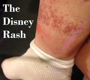 The Disney Rash - Description, prevention and treatment