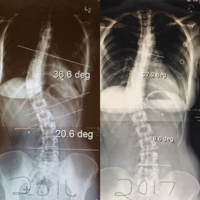 Autumn Onderko Scoliosis xrays.jpg