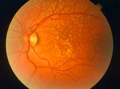 Macular Degeneration: A tale of two types (Dry ARMD)
